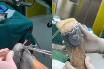 Cứu giữ gót chân dập nát cho người bệnh đa chấn thương 