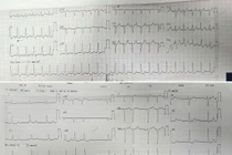 Phối hợp liên viện cấp cứu rối loạn nhịp tim nguy kịch bằng công nghệ cao