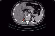 Tiểu khó đi khám người đàn ông phát hiện mắc đồng thời hai loại ung thư