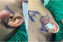 Cô gái 32 tuổi chán nản mất tự tin vì u xơ vành tai lớn tái phát 6 lần