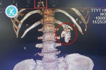 Sốt tiểu buốt kéo dài không khỏi vì sỏi san hô gây nhiễm khuẩn