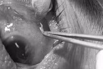 Viêm thủng củng mạc do giun đũa chó mèo chui vào kết mạc