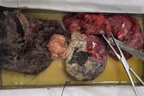 U quái buồng trứng 15 cm vỡ rơi răng và tóc trong bụng bệnh nhân