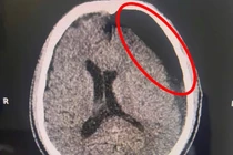 Ngã xe “tưởng nhẹ”, sau 2 tháng mới đau đầu, hôn mê