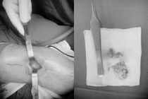 Mắc bệnh hiếm, người đàn ông 37 tuổi xương giòn, yếu như 80 tuổi