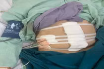 Giành lại sự sống cho bệnh nhân gần 100 tuổi bị thủng hang vị dạ dày