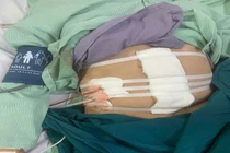 Giành lại sự sống cho bệnh nhân gần 100 tuổi bị thủng hang vị dạ dày