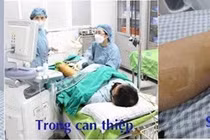 Suy giãn tĩnh mạch vì mỗi ngày đứng liên tục 8 – 12 giờ