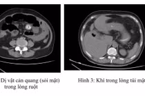 Tắc ruột do sỏi túi mật, “quả bom nổ chậm” ít ai ngờ