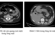 Tắc ruột do sỏi túi mật, “quả bom nổ chậm” ít ai ngờ