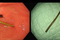 Đau bụng thốc lên ngực, người phụ nữ bị dị vật xuyên ngang thành dạ dày