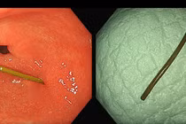 Đau bụng thốc lên ngực, người phụ nữ bị dị vật xuyên ngang thành dạ dày