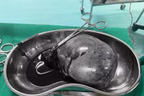 Cứu thai phụ 28 tuần bị u nang buồng trứng xoắn hoại tử 