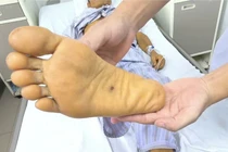 Suy gan, suy thận cấp do xoắn khuẩn Leptospira xâm nhập từ vết thương nhỏ