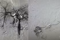 Đang trẻ khỏe bất ngờ vỡ u gan do ung thư