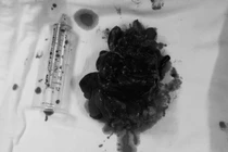 Phụ nữ 54 tuổi phải làm hậu môn nhân tạo vì detox đại tràng 