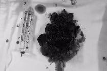 Phụ nữ 54 tuổi phải làm hậu môn nhân tạo vì detox đại tràng 