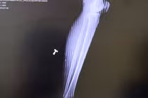 Ăn uống thiếu vệ sinh, nhiều người nhiễm ký sinh trùng nhập viện điều trị