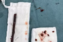 Ngã xuống ao, trẻ 3 tuổi bị cành cây đâm xuyên trực tràng, ruột non 4 tháng