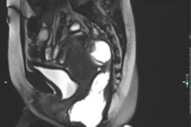 Tiêm búi trĩ không đau người bệnh 35 tuổi biến chứng nặng nề