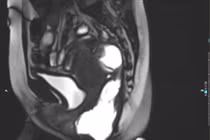 Tiêm búi trĩ không đau người bệnh 35 tuổi biến chứng nặng nề