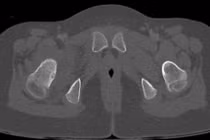 Cứu đôi chân cho bệnh nhi 7 tuổi bị u xương hiếm gặp