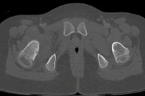 Cứu đôi chân cho bệnh nhi 7 tuổi bị u xương hiếm gặp