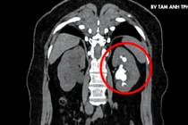 Lấy sỏi san hồ lấp đầy đài bể thận cho người phụ nữ 51 tuổi