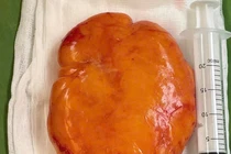 Giúp người phụ nữ thoát khỏi khối u mỡ khổng lồ ở lưng