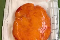 Giúp người phụ nữ thoát khỏi khối u mỡ khổng lồ ở lưng