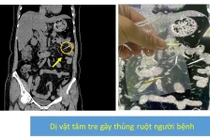 Xương cá, tăm tre dài 3 cm đâm xuyên thành ruột 2 bệnh nhân