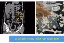 Xương cá, tăm tre dài 3 cm đâm xuyên thành ruột 2 bệnh nhân