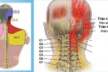 Đốt sống cao tần trị đau đầu xuất phát từ đốt sống cổ