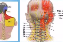 Đốt sống cao tần trị đau đầu xuất phát từ đốt sống cổ