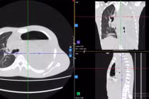 Kịp thời cứu sống lá phổi suýt bị “hủy hoại” do tràn mủ màng phổi phức tạp