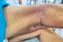 Cứu sống bệnh nhân ngừng tim, sốc nhiễm khuẩn do ong đốt hóa mủ