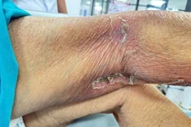 Cứu sống bệnh nhân ngừng tim, sốc nhiễm khuẩn do ong đốt hóa mủ