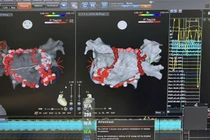 Chỉ 4 giây mỗi điểm đốt rung nhĩ giúp bệnh nhân giảm biến cố tim mạch