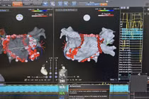 Chỉ 4 giây mỗi điểm đốt rung nhĩ giúp bệnh nhân giảm biến cố tim mạch