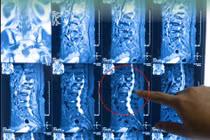 Phẫu thuật thành công ca xẹp đốt sống ở cụ bà 77 tuổi