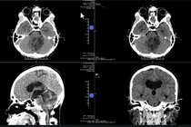 Liệt lưỡi do u não chèn ép thần kinh, bay từ Mỹ về Việt Nam giải cứu