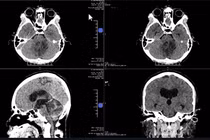 Liệt lưỡi do u não chèn ép thần kinh, bay từ Mỹ về Việt Nam giải cứu