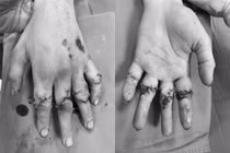 Phẫu thuật vi phẫu nối chi thể đứt rời cứu bàn tay tổn thương nặng