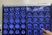 U não tái phát thần tốc, bệnh nhân vượt cửa tử qua ca phẫu thuật căng não