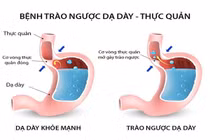 Thay đổi chế độ ăn uống chữa trào ngược dạ dày – thực quản