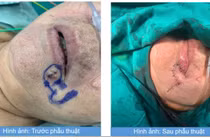 Khối u da bất thường vùng môi dưới không ngờ ung thư