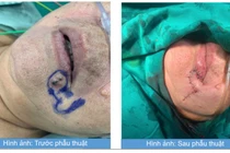 Khối u da bất thường vùng môi dưới không ngờ ung thư