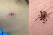 Sốt mò, bệnh truyền nhiễm, ấu trùng mò, suy tim, suy thận, suy hô hấp, sốt