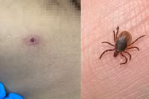 Sốt mò, bệnh truyền nhiễm, ấu trùng mò, suy tim, suy thận, suy hô hấp, sốt