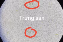 Thích ăn đồ tái sống, người đàn ông 64 tuổi bị sán lá gan gây tắc mật